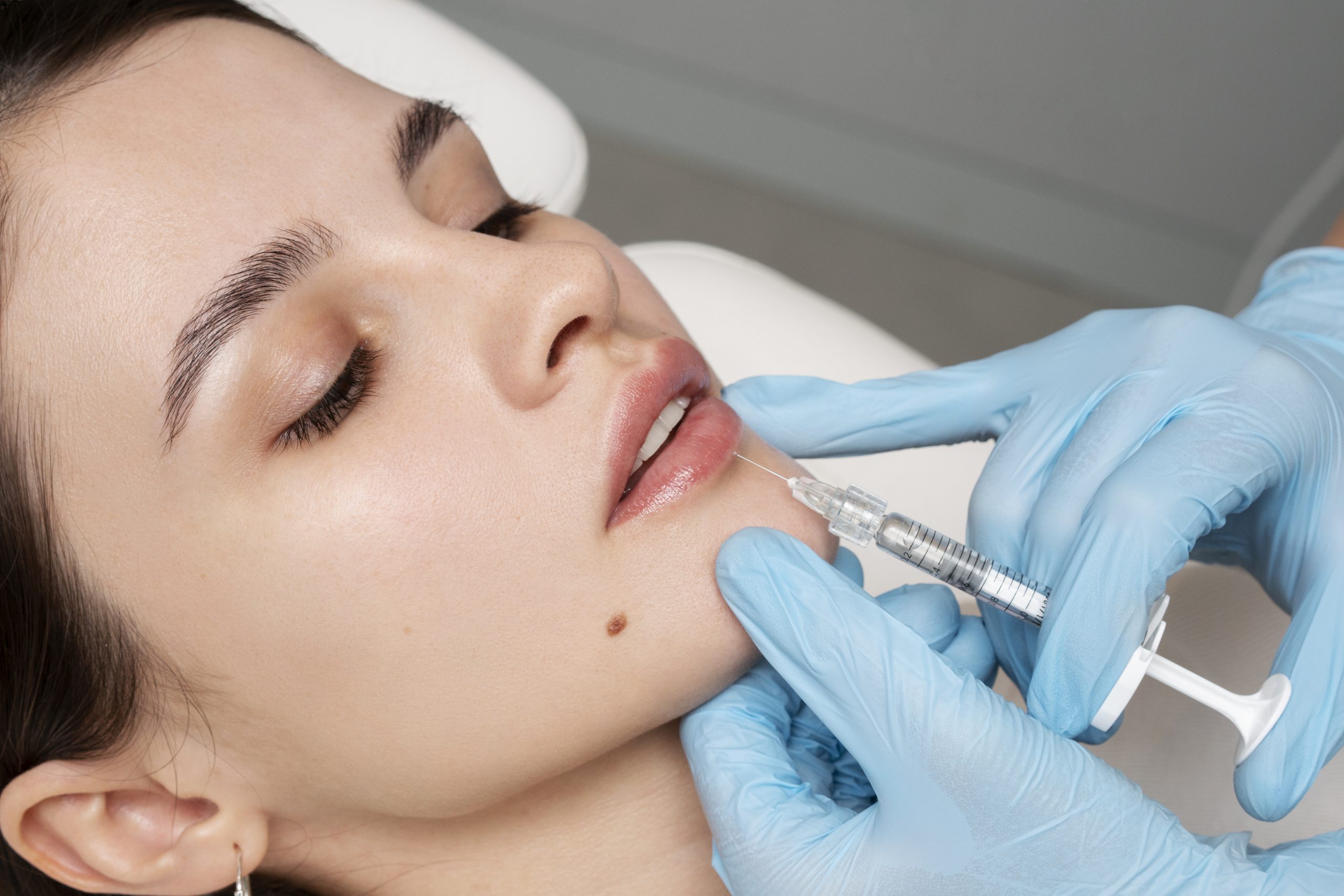 Filler labbra e trattamenti estetici a base di acido ialuronico a Vicenza Filler labbra e trattamenti estetici a base di acido ialuronico a Vicenza
